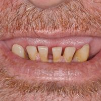 Smile In A Day - Smile 13 before